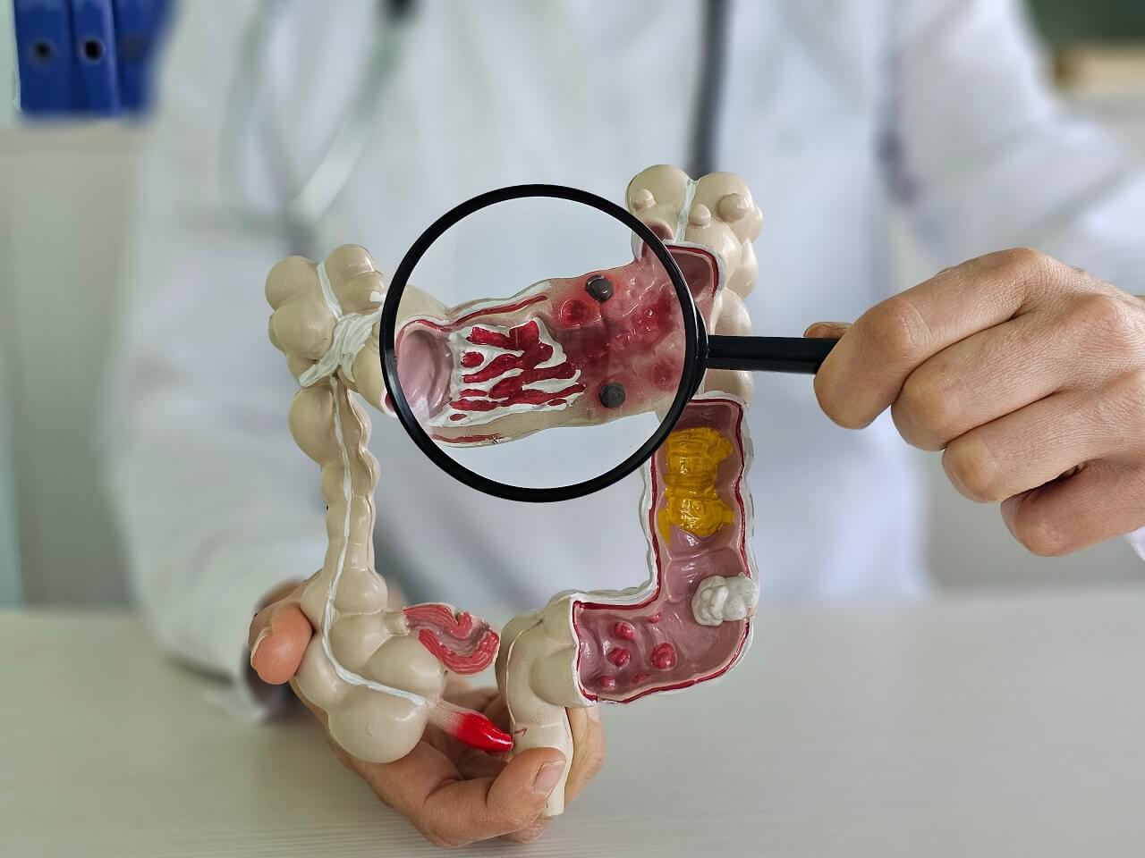 Câncer Colorretal: Quase 2 Milhões de Novos Casos