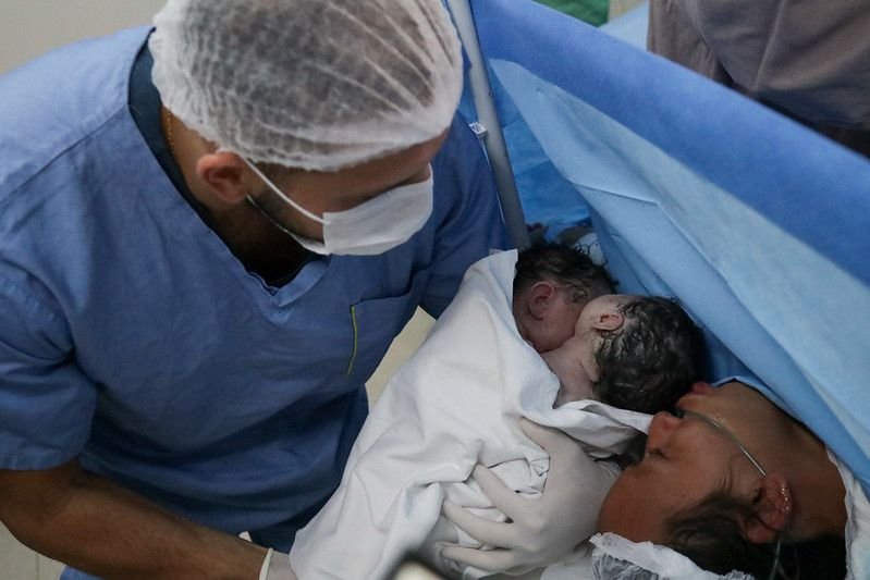 Parto raro de gêmeas siamesas é realizado com sucesso na rede pública de saúde do Amazonas