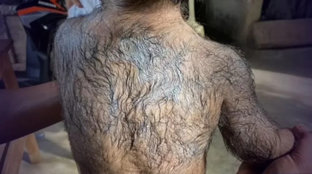 Anvisa alerta para risco de hipertricose em bebês expostos a remédio para calvície minoxidil