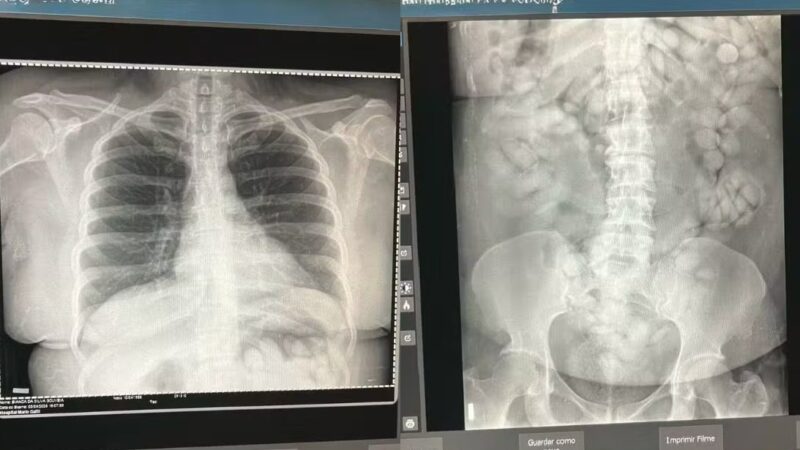 Mulher é presa com 100 cápsulas de cocaína no estômago