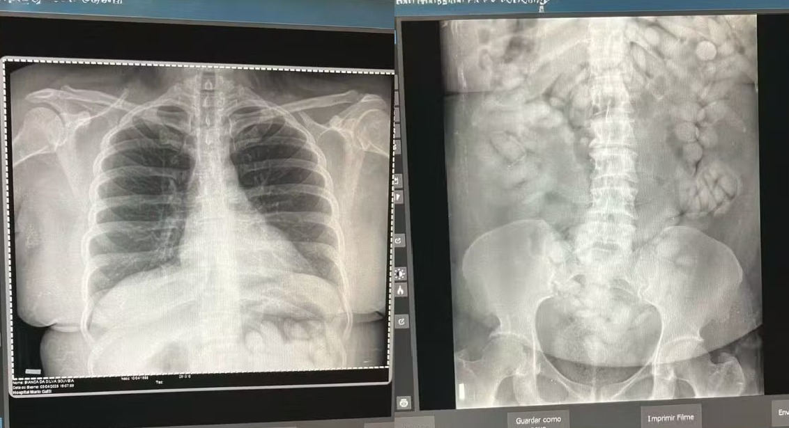 Mulher é presa com 100 cápsulas de cocaína no estômago