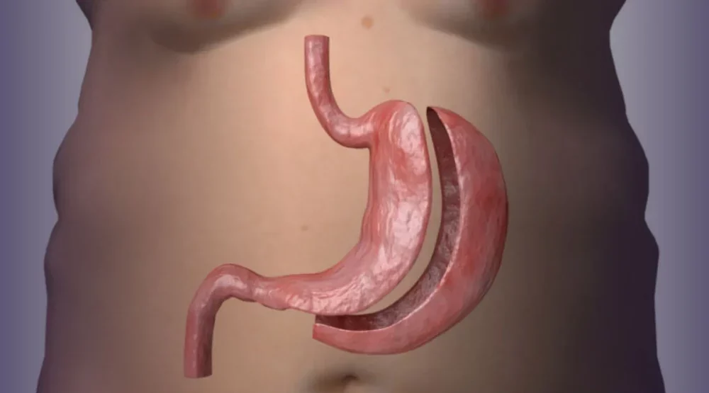 CFM publica resolução que estabelece novos parâmetros para a cirurgia bariátrica e metabólica no Brasil