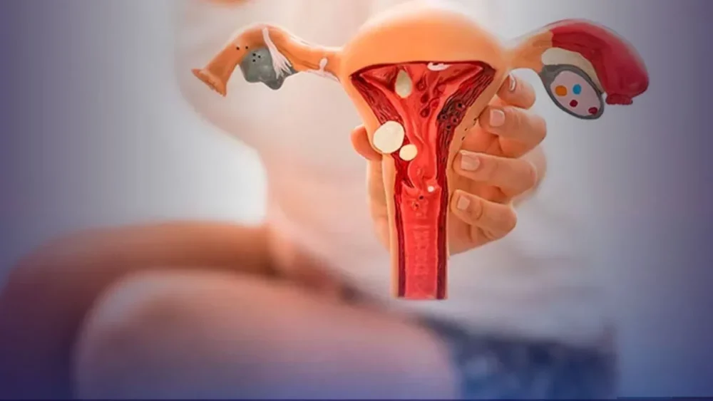 SUS disponibiliza dois novos tratamentos para endometriose em 2025