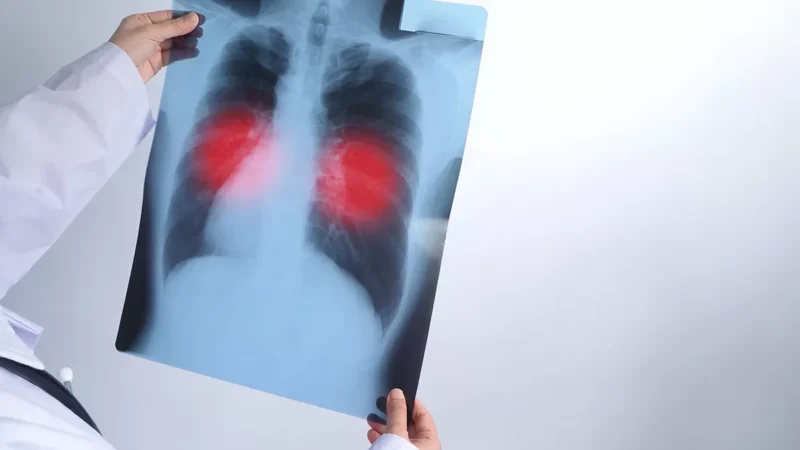 Óbitos por tuberculose recuam 14,8% no Amazonas em 2026