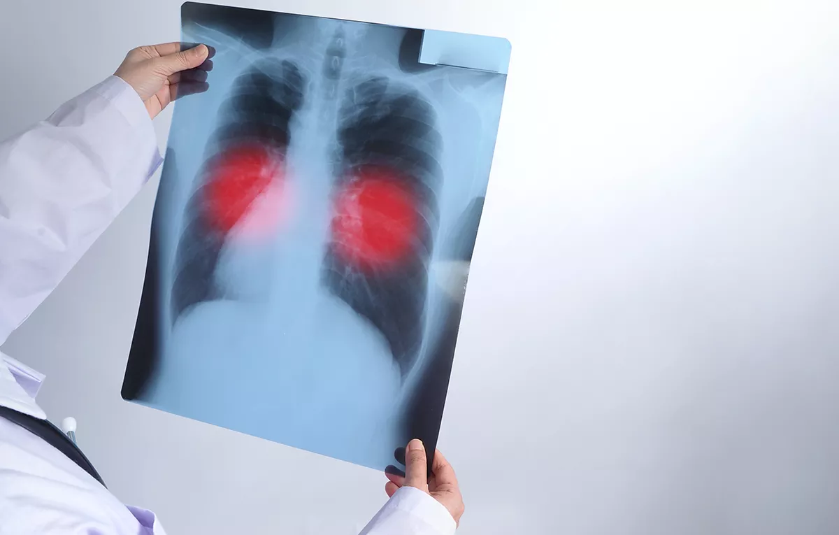 Óbitos por tuberculose recuam 14,8% no Amazonas em 2026